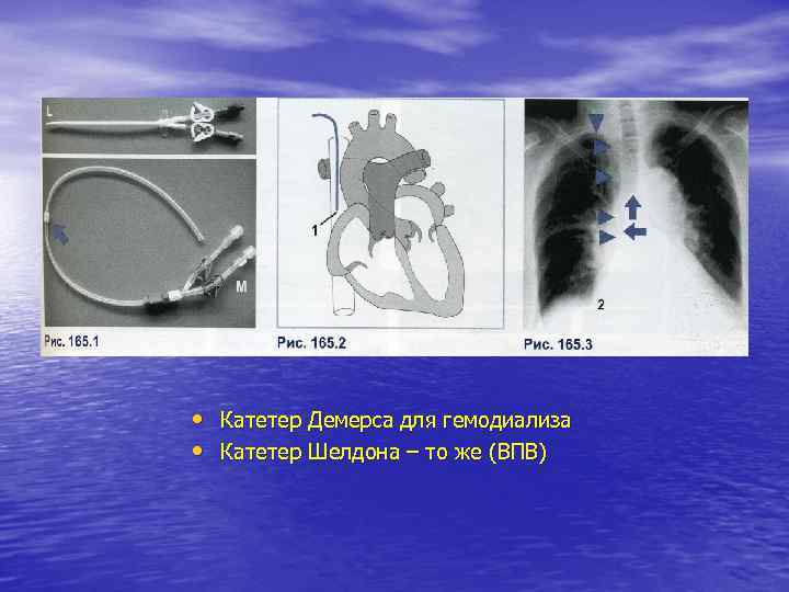  • Катетер Демерса для гемодиализа • Катетер Шелдона – то же (ВПВ) 