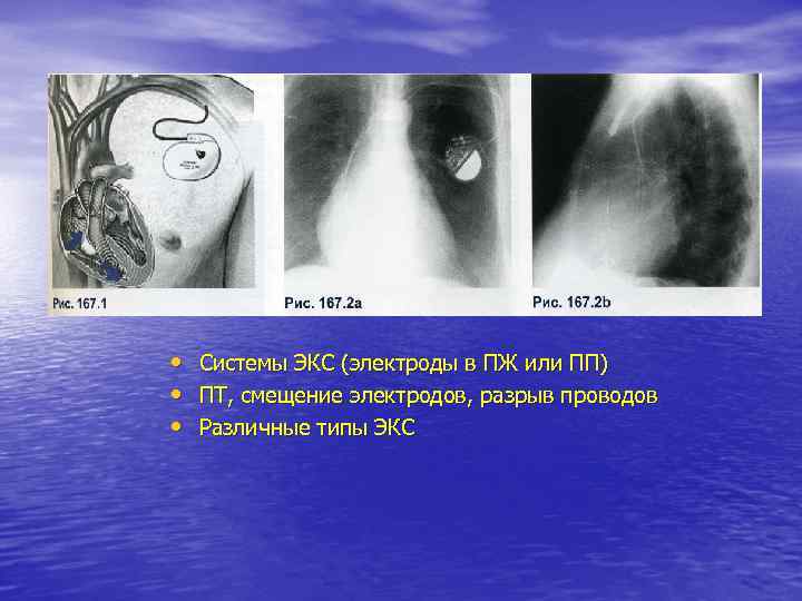  • Системы ЭКС (электроды в ПЖ или ПП) • ПТ, смещение электродов, разрыв