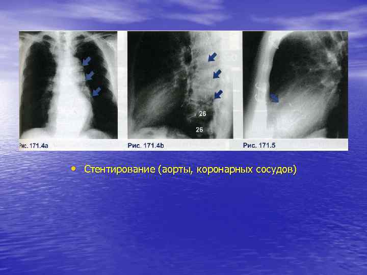  • Стентирование (аорты, коронарных сосудов) 