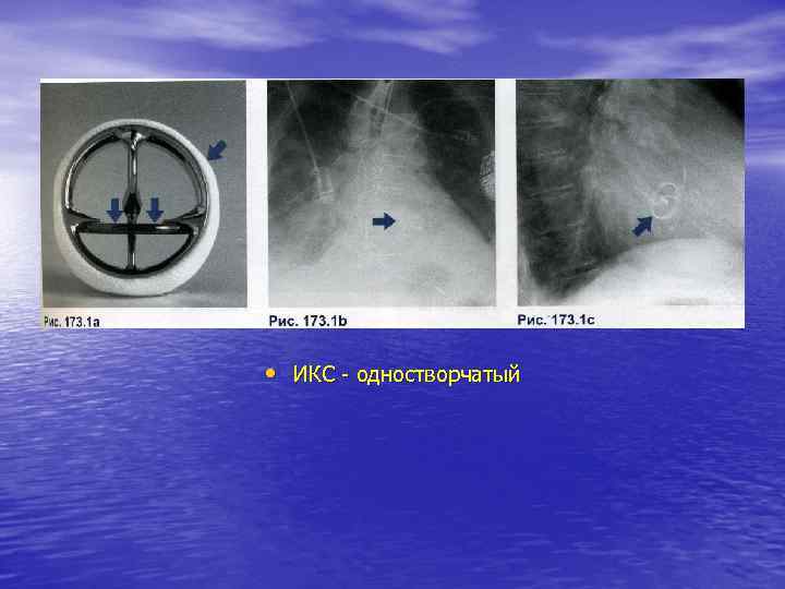  • ИКС - одностворчатый 