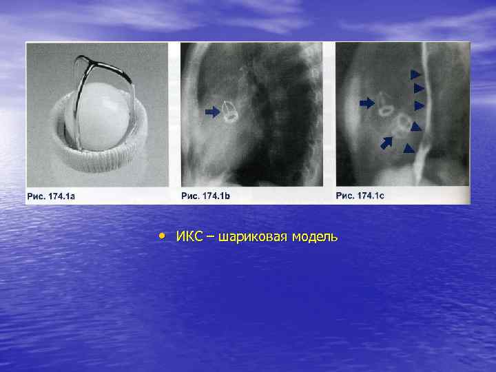  • ИКС – шариковая модель 