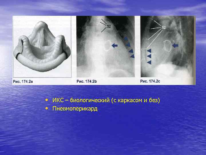 • ИКС – биологический (с каркасом и без) • Пневмоперикард 