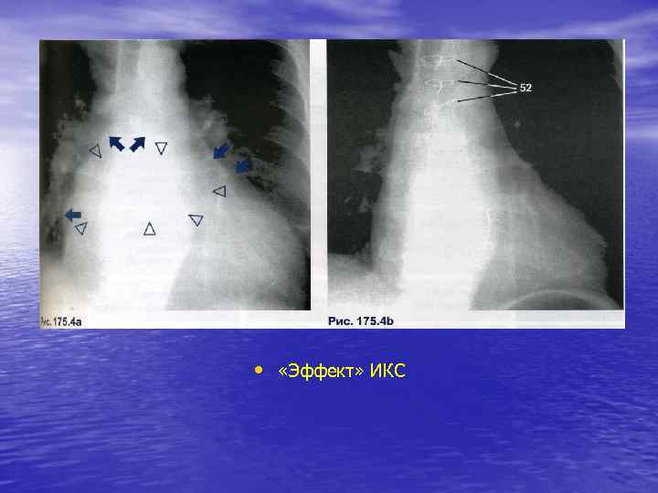  • «Эффект» ИКС 