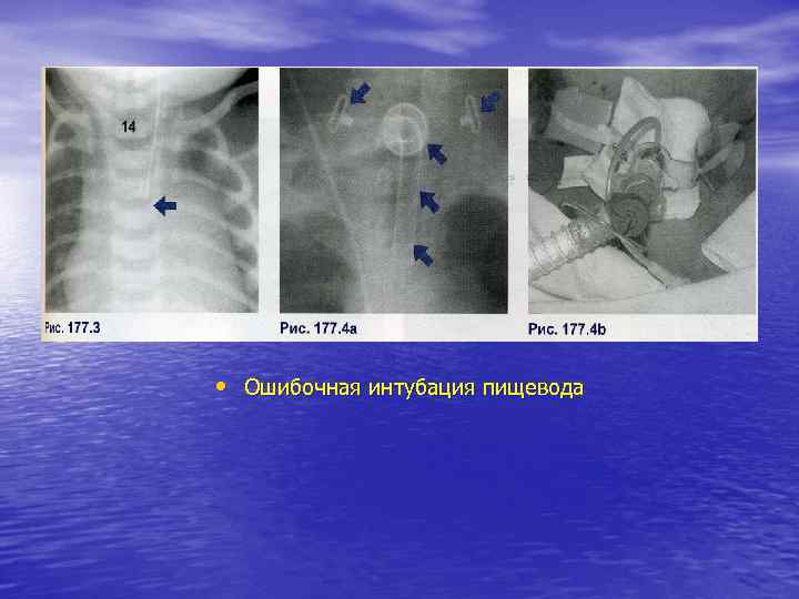  • Ошибочная интубация пищевода 