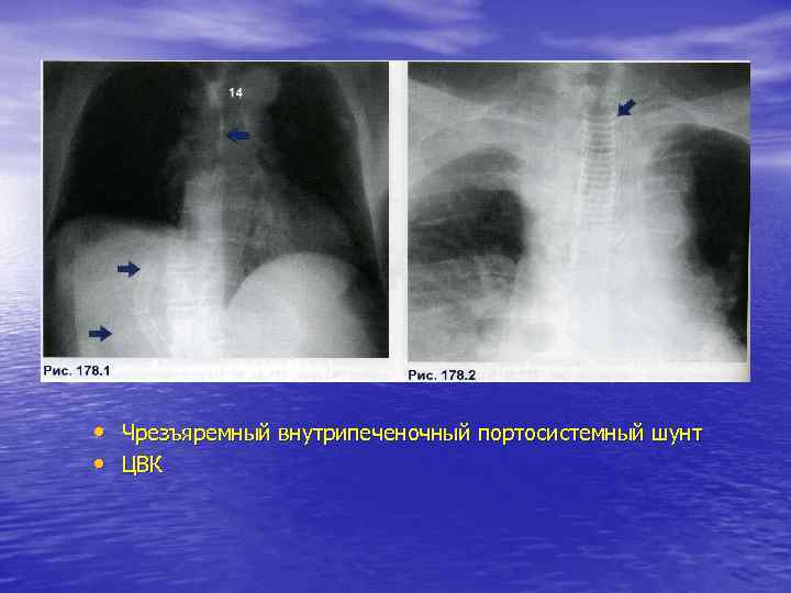  • Чрезъяремный внутрипеченочный портосистемный шунт • ЦВК 