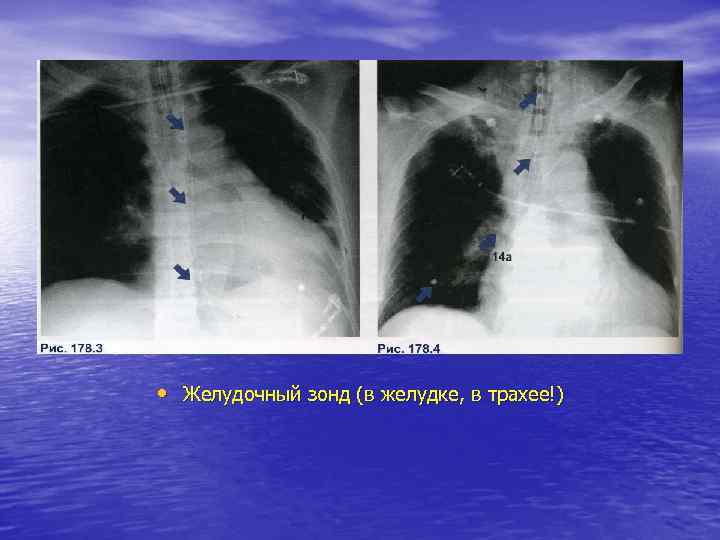  • Желудочный зонд (в желудке, в трахее!) 