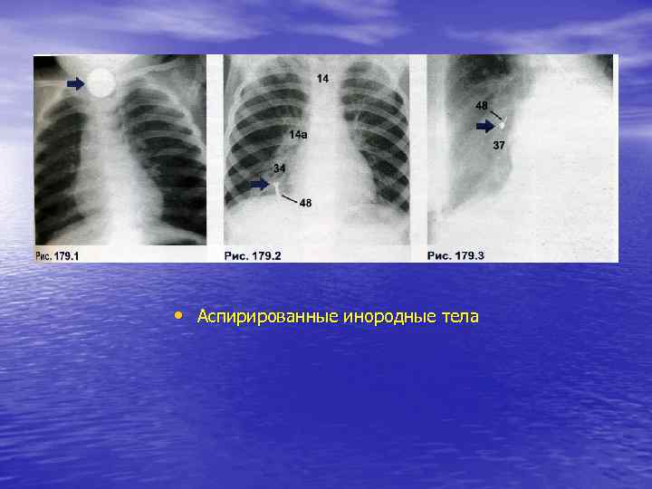  • Аспирированные инородные тела 