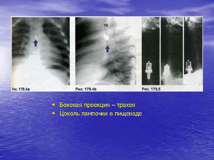  • Боковая проекция – трахея • Цоколь лампочки в пищеводе 