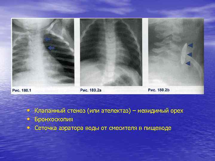  • • • Клапанный стеноз (или ателектаз) – невидимый орех Бронхоскопия Сеточка аэратора