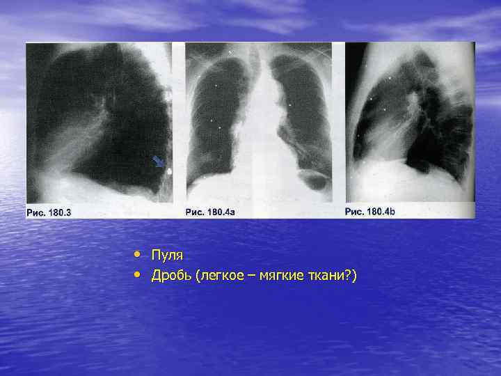  • Пуля • Дробь (легкое – мягкие ткани? ) 