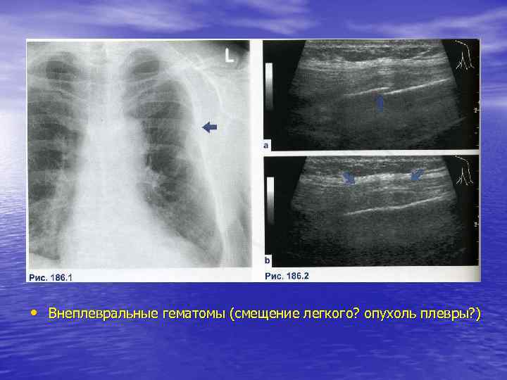  • Внеплевральные гематомы (смещение легкого? опухоль плевры? ) 