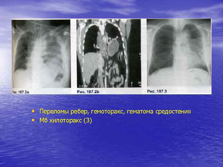  • Переломы ребер, гемоторакс, гематома средостения • Мб хилоторакс (3) 