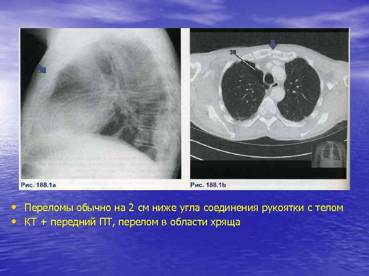  • Переломы обычно на 2 см ниже угла соединения рукоятки с телом •