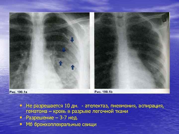  • Не разрешается 10 дн. - ателектаз, пневмония, аспирация, • • гематома –
