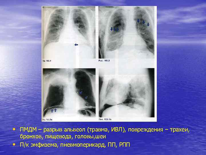  • ПМДМ – разрыв альвеол (травма, ИВЛ), повреждения – трахеи, • бронхов, пищевода,