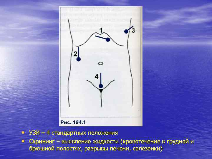  • УЗИ – 4 стандартных положения • Скрининг – выявление жидкости (кровотечение в
