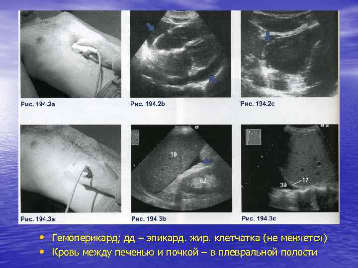  • Гемоперикард; дд – эпикард. жир. клетчатка (не меняется) • Кровь между печенью