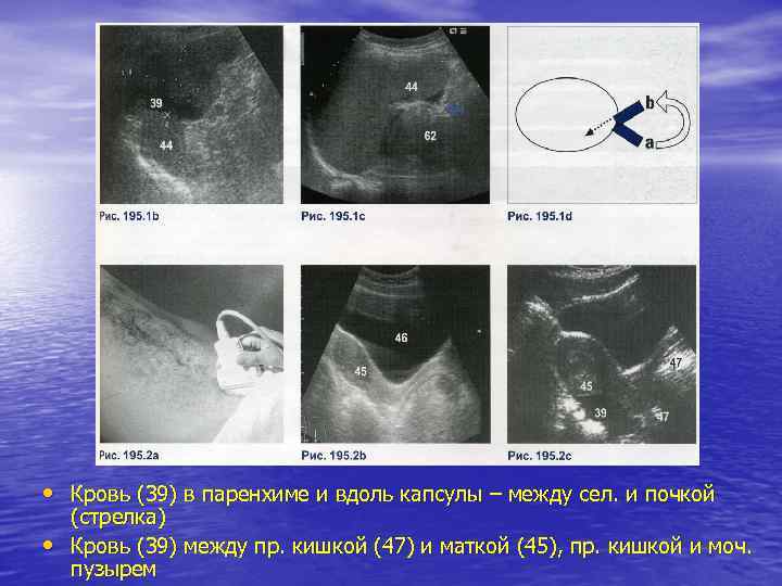  • Кровь (39) в паренхиме и вдоль капсулы – между сел. и почкой