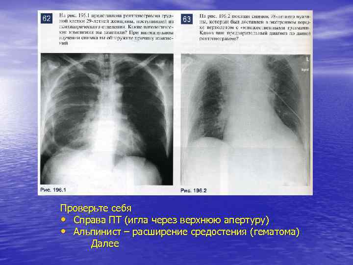 Проверьте себя • Справа ПТ (игла через верхнюю апертуру) • Альпинист – расширение средостения