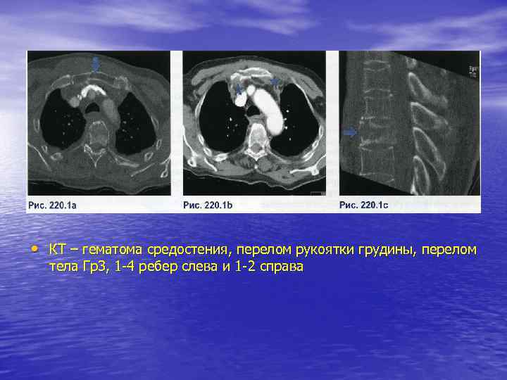  • КТ – гематома средостения, перелом рукоятки грудины, перелом тела Гр3, 1 -4