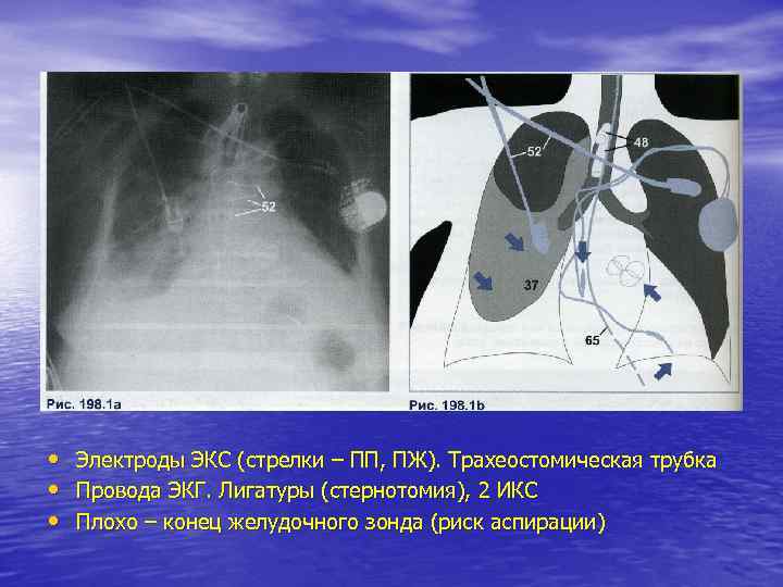  • • • Электроды ЭКС (стрелки – ПП, ПЖ). Трахеостомическая трубка Провода ЭКГ.
