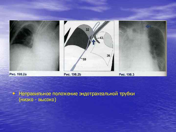 • Неправильное положение эндотрахеальной трубки (низко - высоко) 