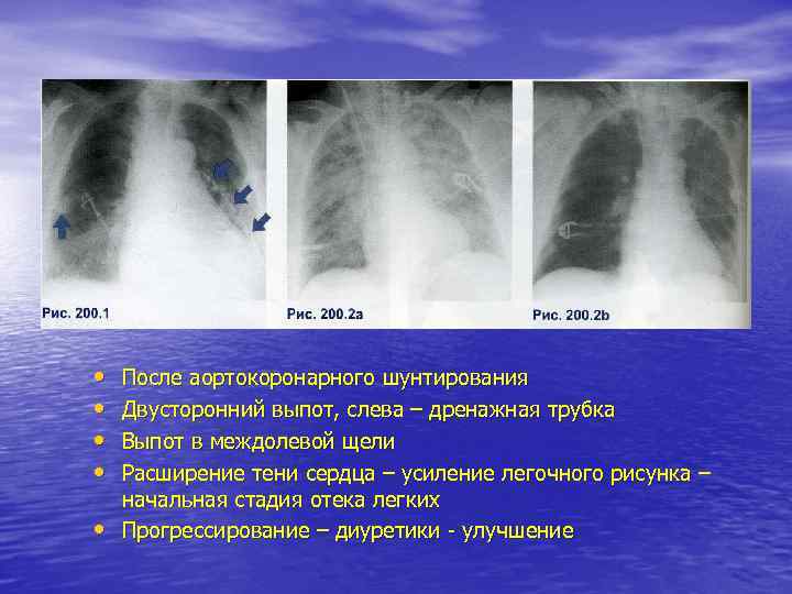 Обогащение легочного рисунка на рентгене у ребенка