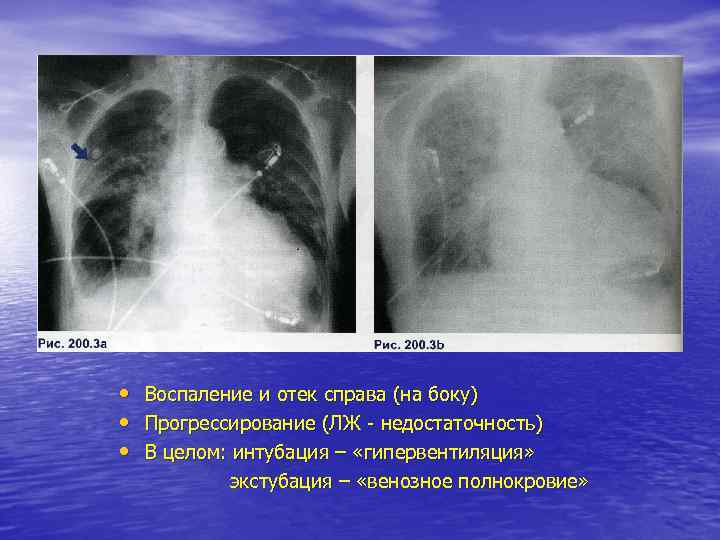  • Воспаление и отек справа (на боку) • Прогрессирование (ЛЖ - недостаточность) •