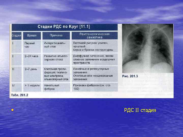  • РДС ІІ стадия 