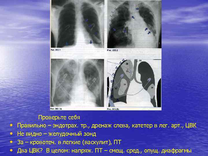  • • Проверьте себя Правильно – эндотрах. тр. , дренаж слева, катетер в