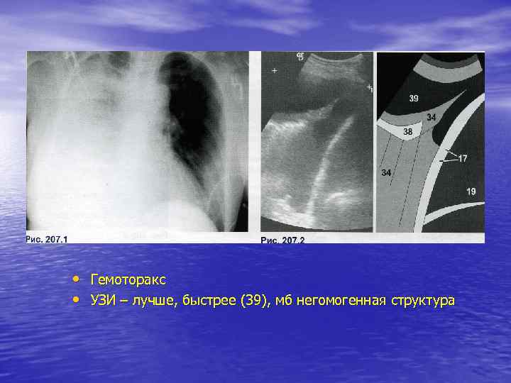  • Гемоторакс • УЗИ – лучше, быстрее (39), мб негомогенная структура 