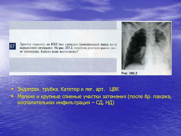  • Эндотрах. трубка. Катетер в лег. арт. ЦВК • Мелкие и крупные сливные