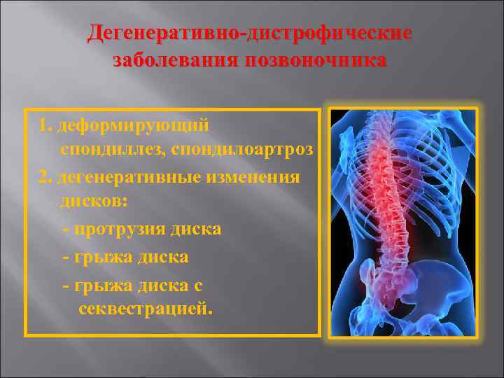 Дегенеративно-дистрофические заболевания позвоночника 1. деформирующий спондиллез, спондилоартроз 2. дегенеративные изменения дисков: - протрузия диска