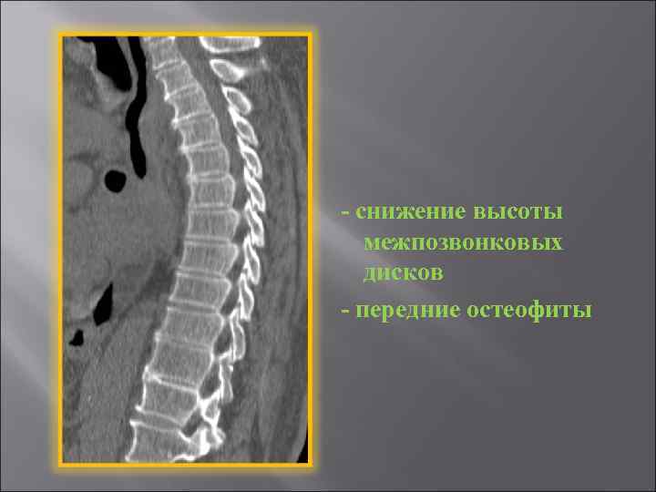 Увеличение высоты межпозвонковых дисков