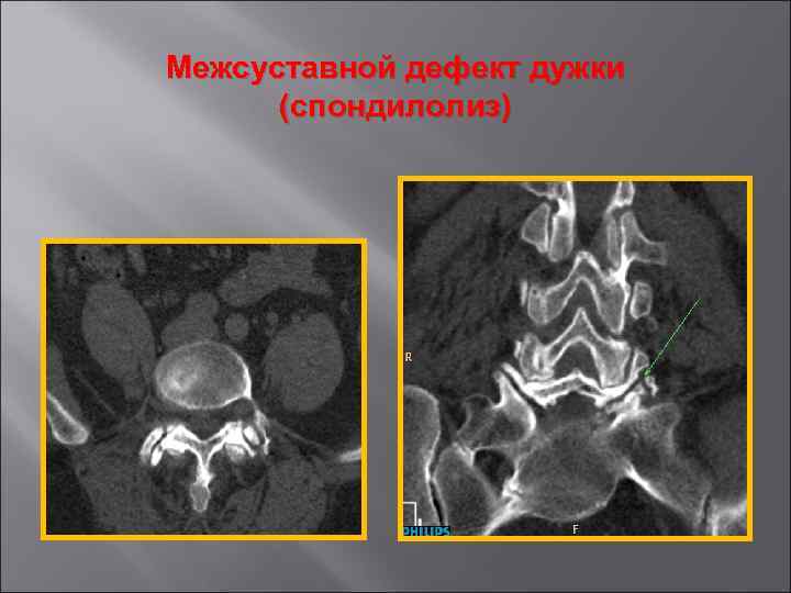 Межсуставной дефект дужки (спондилолиз) 