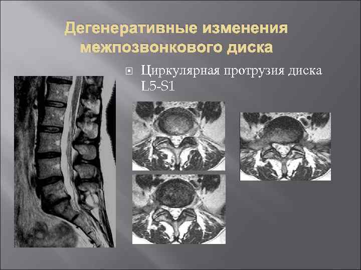 Дистрофические изменения в мозгу