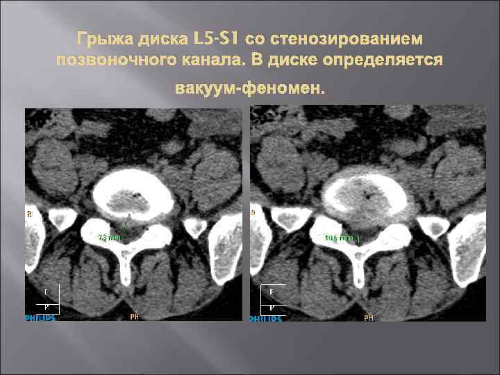 Диск для компьютерной томографии