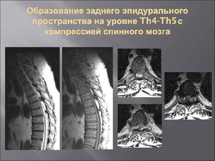 Образование заднего эпидурального пространства на уровне Th 4 -Th 5 с компрессией спинного мозга