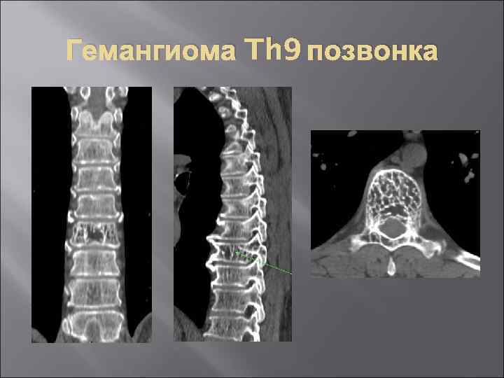 Гемангиома Th 9 позвонка 
