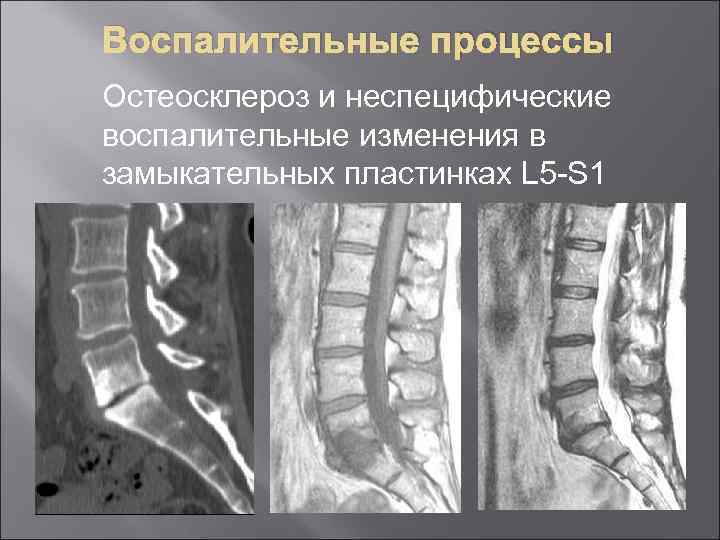 Остеосклероз замыкательных пластин тел позвонков. Дегенеративные изменения замыкательных пластин. Субхондральный остеосклероз замыкательных пластинок. Остеосклероз смежных замыкательных пластинок тел позвонков.