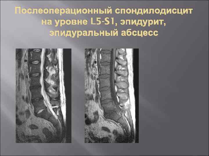 Спондилодисцит позвоночника что это