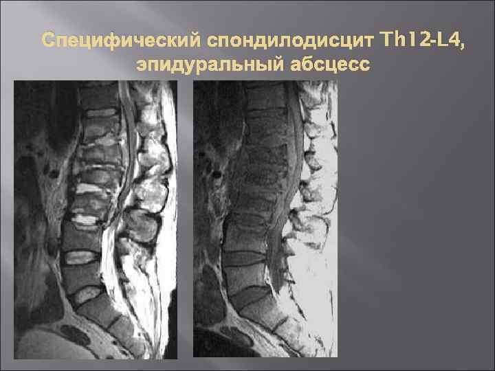 Спондилодисцит это