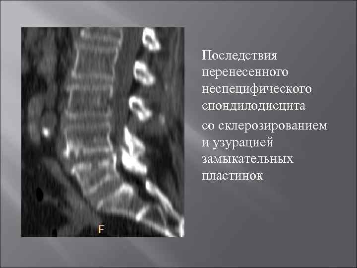 Склероз замыкательных пластинок позвоночника