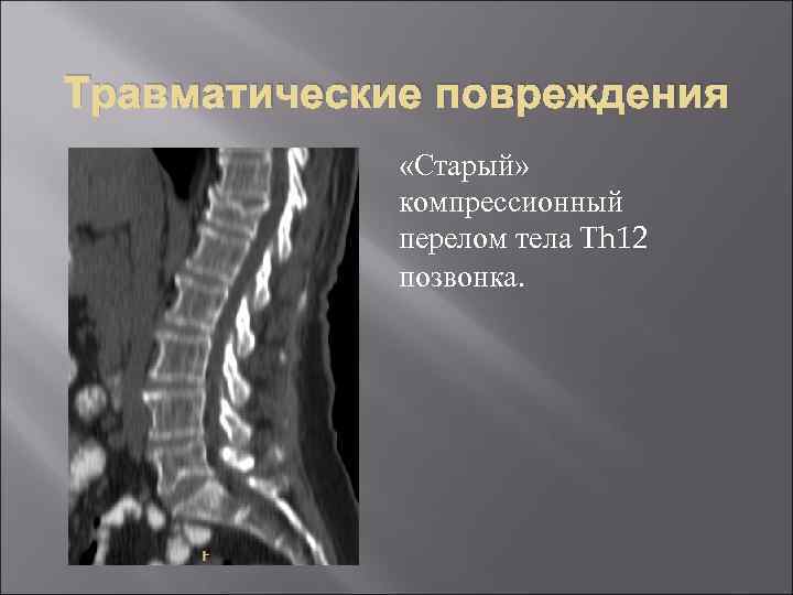 Компрессионный перелом позвоночника что это такое у детей фото и последствия