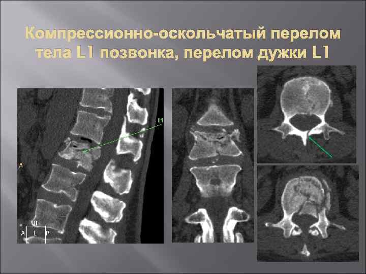 Оскольчатый перелом позвонка