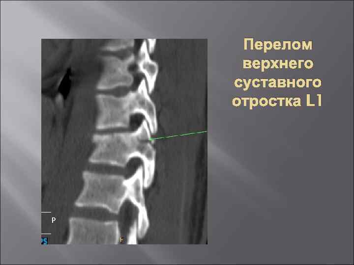 Перелом верхнего суставного отростка L 1 