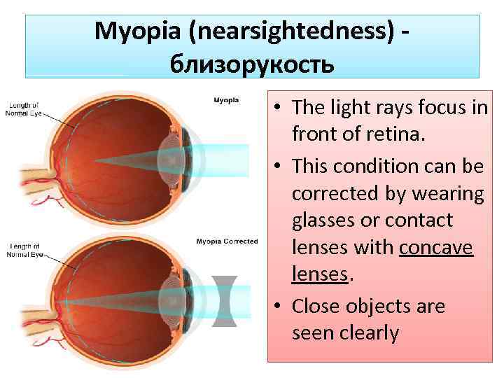 Myopia (nearsightedness) близорукость • The light rays focus in front of retina. • This