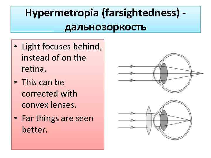 Hypermetropia (farsightedness) дальнозоркость • Light focuses behind, instead of on the retina. • This