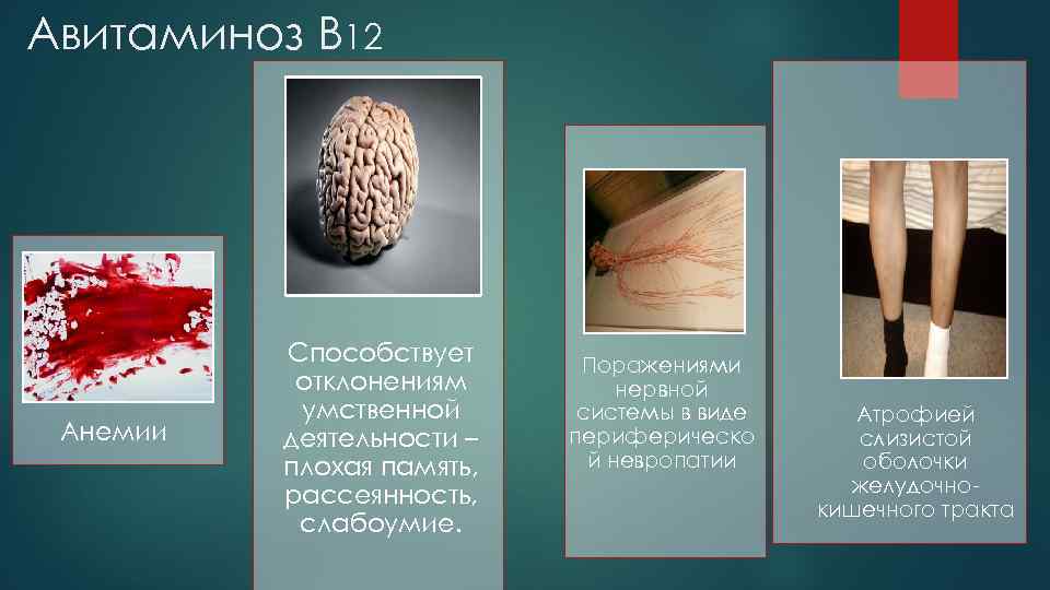 Авитаминоз В 12 Анемии Способствует отклонениям умственной деятельности – плохая память, рассеянность, слабоумие. Поражениями