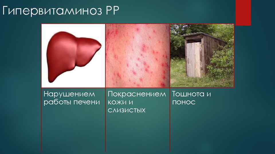 Гипервитаминоз РР Нарушением работы печени Покраснением Тошнота и кожи и понос слизистых 